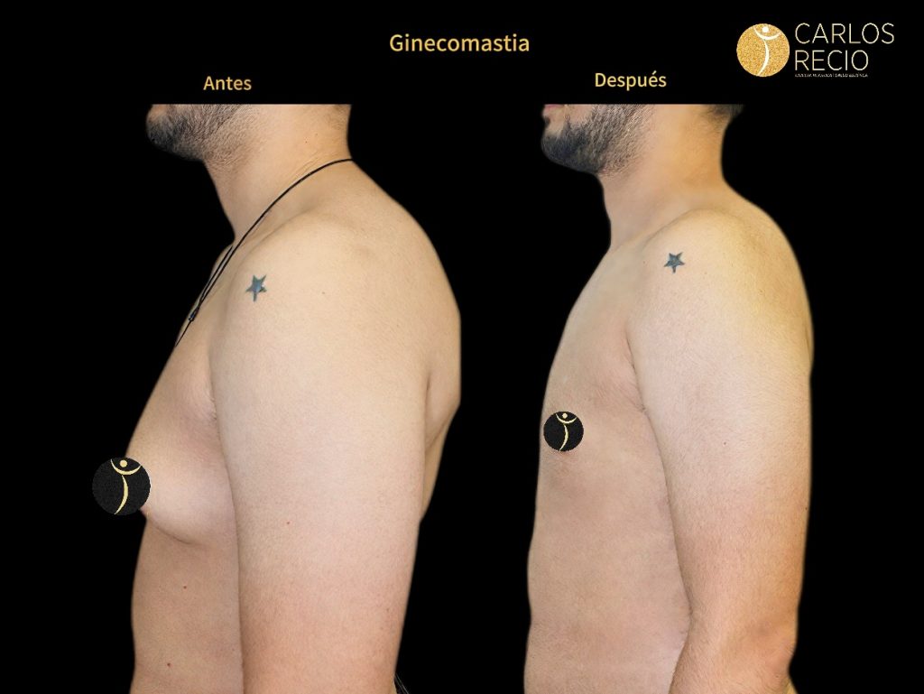 Ginecomastia: tipos, causas y cuándo la cirugía es la solución correcta para los hombres Ginecomastia: tipos, causas y cuándo la cirugía es la solución correcta para los hombres